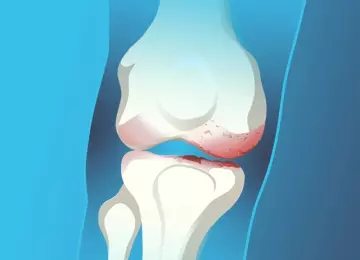 Les injections en combinaison avec l’orthèse OdrA | Une solution efficace pour l’arthrose du genou