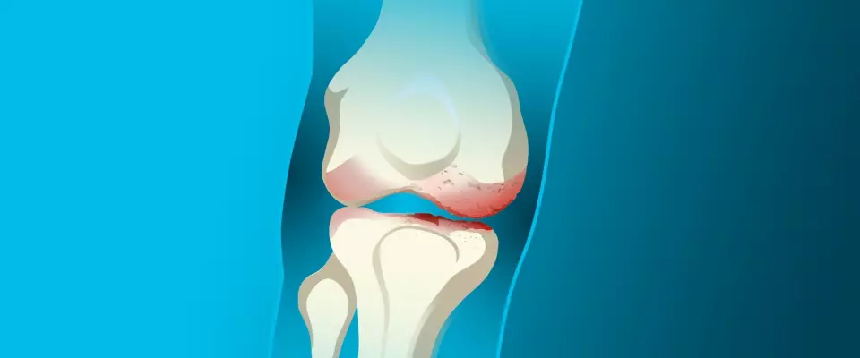 Les injections en combinaison avec l’orthèse OdrA | Une solution efficace pour l’arthrose du genou
