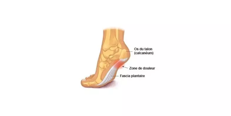 Fasciite plantaire pathologie pied