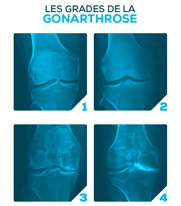 Site grades Gonarthrose